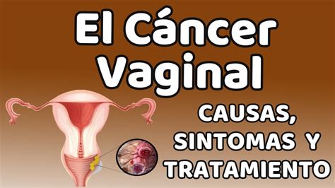 cancer na vagina